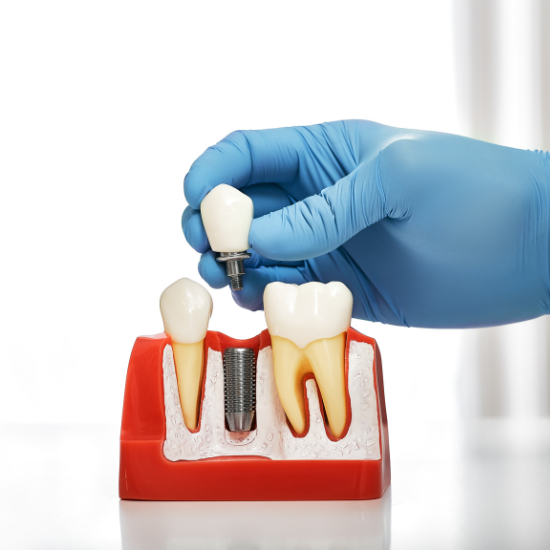 A gloved hand holds a tooth-shaped object with a metal post above a dental model showing teeth and a visible metal screw embedded in a red base.
