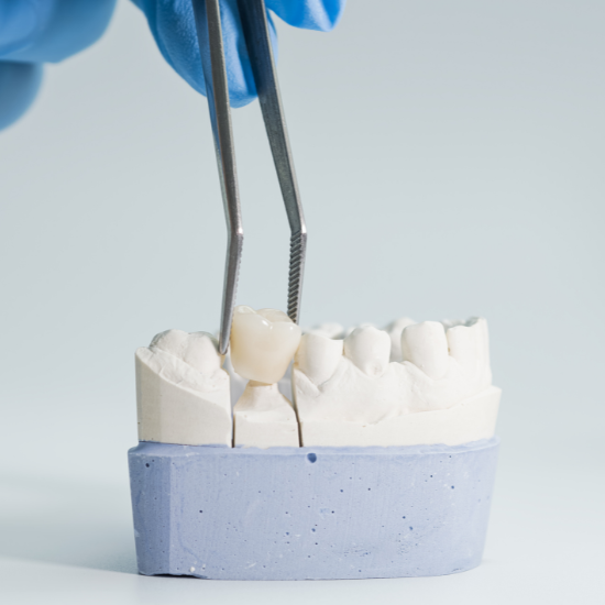 A gloved hand uses metal tweezers to hold a tooth-shaped object above a white dental model mounted on a blue base.